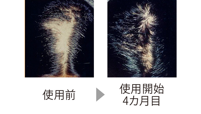 ストレスにより自分で毛を抜いてしまう抜毛症の症例。髪の薄くなった部分にCTPの製剤を使い、4カ月目でここまで回復。自然に生えるよりも早く治った。（三省製薬調べ）