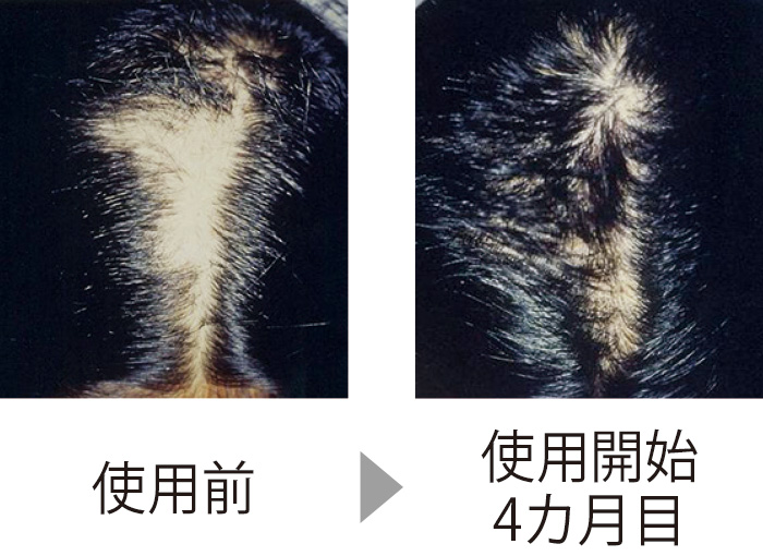 自分で髪を抜いてしまう抜毛症（ばつもうしょう）の症例。CTPの製剤を使い、4カ月でここまで生え揃った。自然に生えるよりも早く治った。（三省製薬調べ）