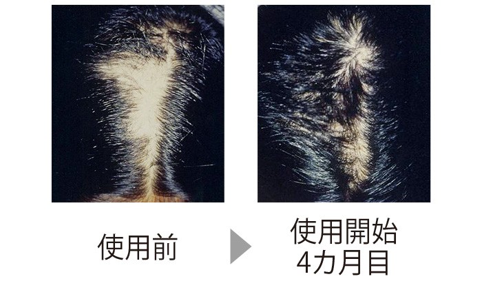 自分で髪を抜いてしまう抜毛症（ばつもうしょう）の症例。CTPの製剤を使い、4カ月でここまで生え揃った。自然に生えるよりも早く治った。（三省製薬調べ）