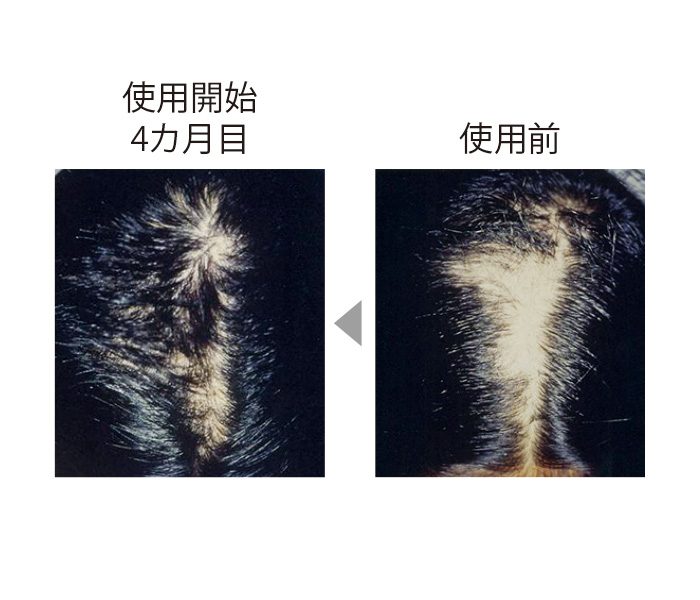 自分で髪を抜いてしまう抜毛症の症例。CTPの製剤を使い、4カ月でここまで生え揃った。 (三省製薬調べ)